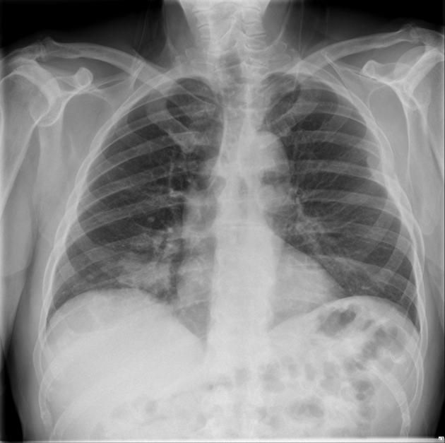 X-ray Detection